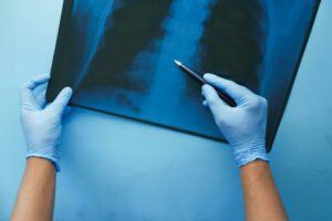 El 75% de las fracturas vertebrales osteoporóticas no se diagnostican por la falta de síntomas claros