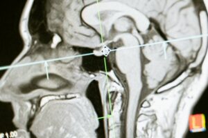 Un nuevo escáner cerebral detecta la proteína tau del alzhéimer antes que el método estándar actual