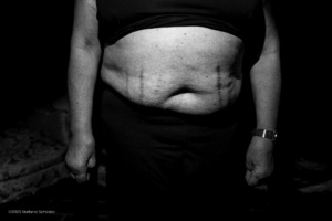 El síndrome de Cushing y el problema de tener niveles desorbitados de cortisol