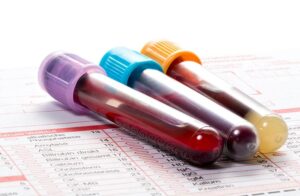 La OMS impulsa nuevas medidas para mejorar el tratamiento de niños con enfermedad de células falciformes