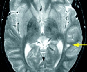 cerebro de un joven con sindrome de asperger