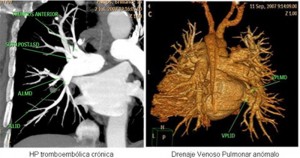 tac hipertensión pulmonar