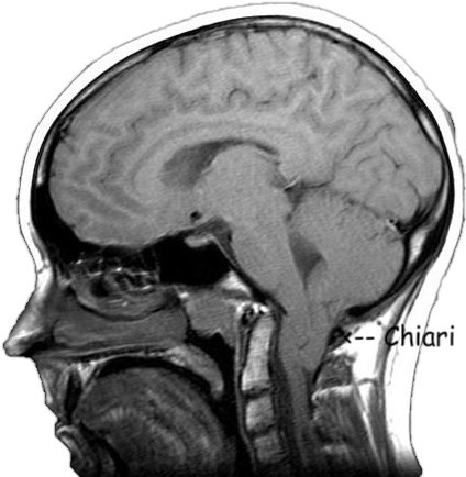 Malformación Chiari