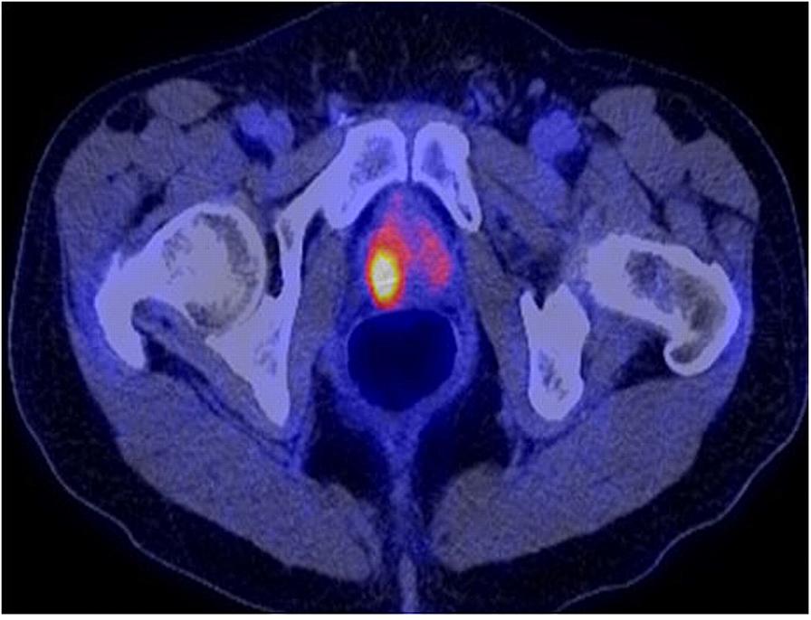 imunitatea prostatitei psa libero valori