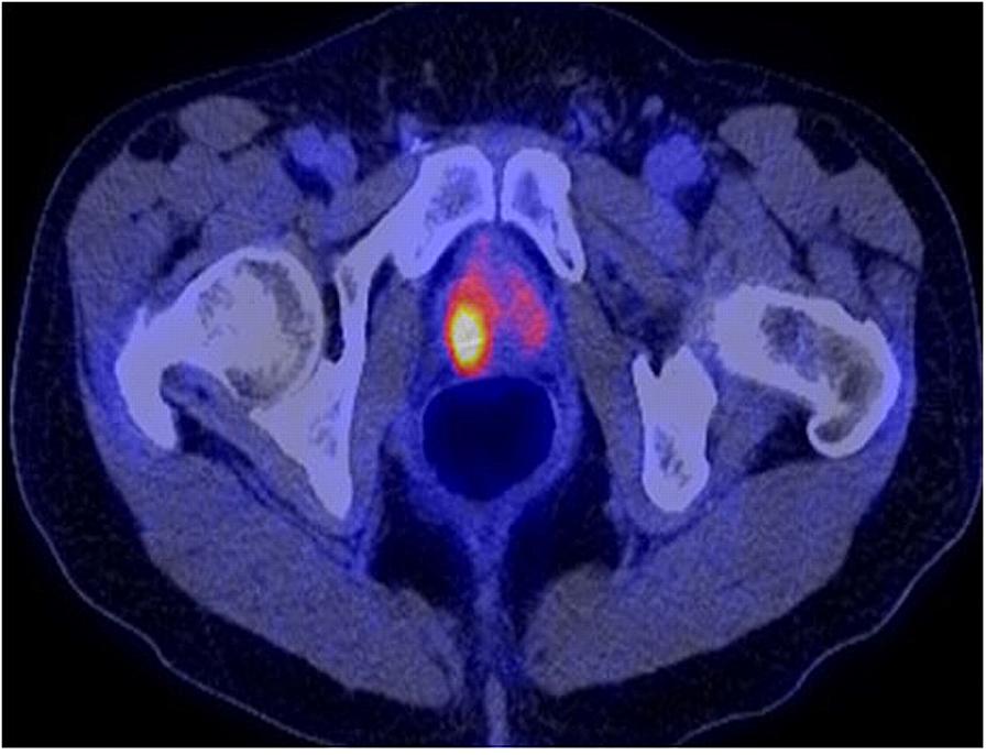 autoanalisis próstata frunze de mesteacăn pentru prostatită