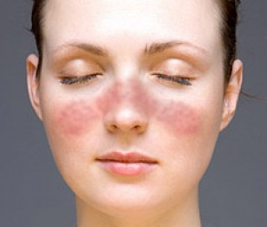 lupus eritematoso sistémico