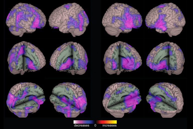 Epilepsia: atención multidisciplinar y centros de referencia