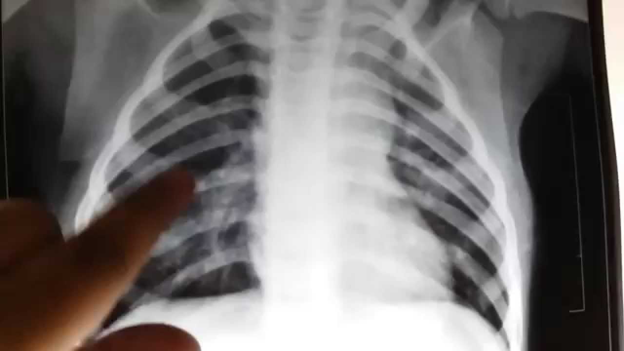 I Foro de Hipertensión Pulmonar de la FCHP, el próximo viernes en Sevilla