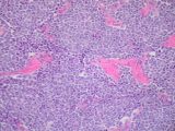 Hoy sábado, 13 de julio, se celebra el Día Internacional del Sarcoma Hoy sábado, 13 de julio, se celebra el Día Internacional del Sarcoma