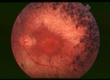 Investigación en distrofias hereditarias de retina