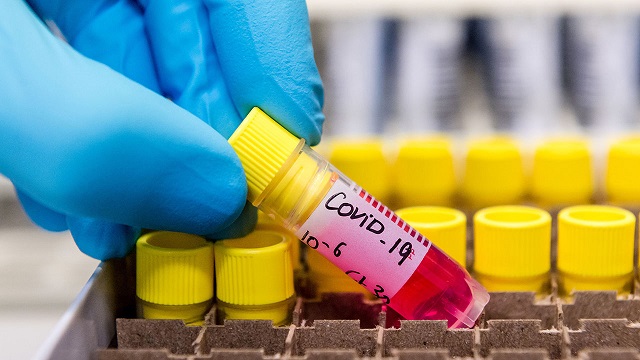 Estudio internacional sobre el coronavirus en el síndrome de Down