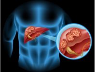 colangiocarcinoma