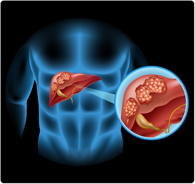 colangiocarcinoma