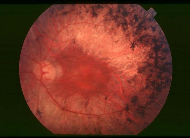 Retinosis pigmentaria: sin investigación no hay curación