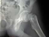 Prevenir cada año 1.200 fracturas óseas por la osteoporosis