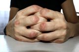 Hablemos de artritis psoriásica Hablemos de artritis psoriásica