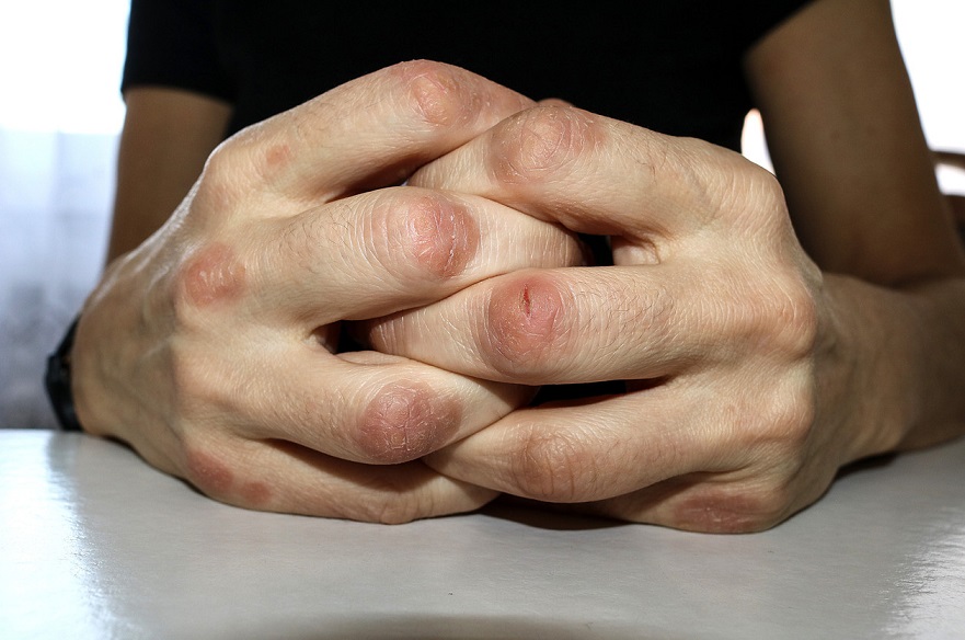 Hablemos de artritis psoriásica