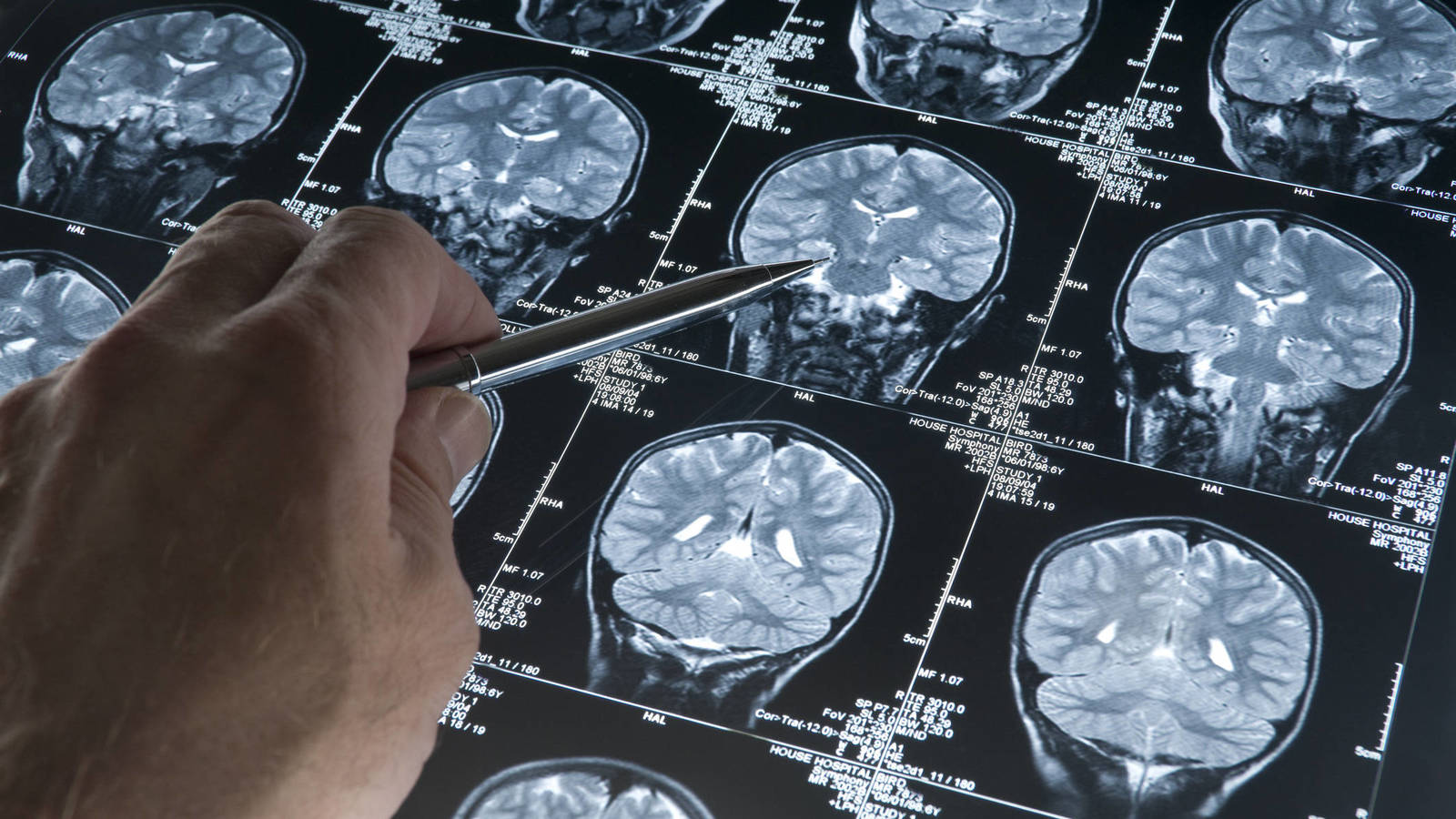 4,5 millones de pesetas para la investigación del alzhéimer