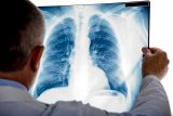 Becas para la investigación social en cáncer de pulmón Becas para la investigación social en cáncer de pulmón