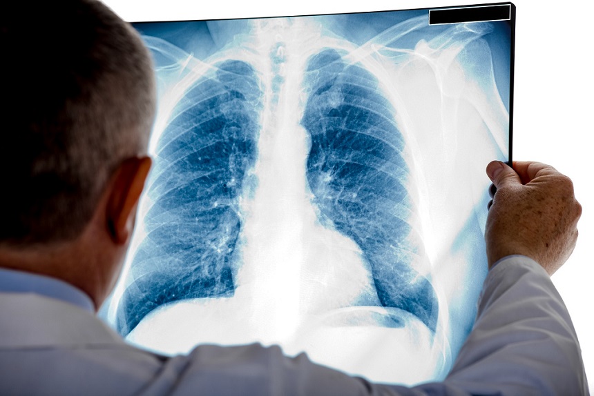 Becas para la investigación social en cáncer de pulmón