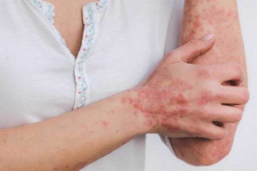 Jornadas para la formación y educación psicoemocional en la psoriasis