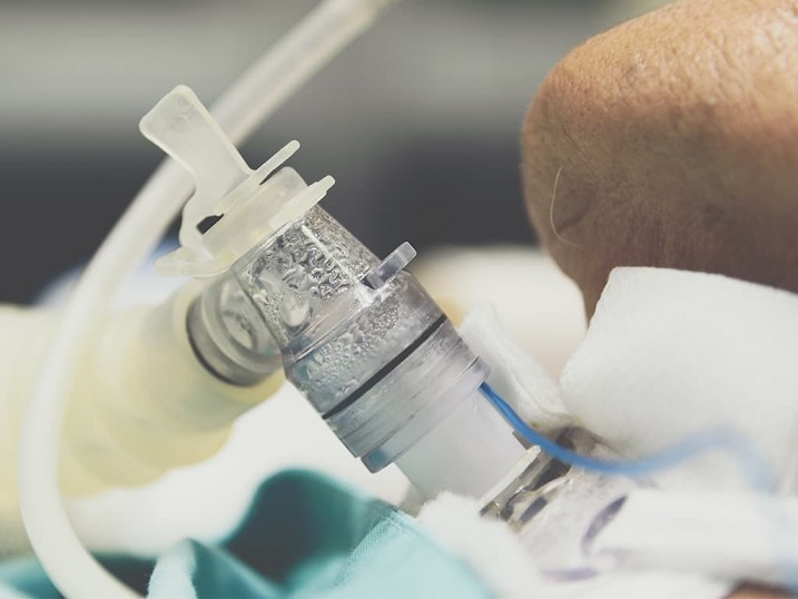 Retos de la traqueostomía en pacientes de Esclerosis Lateral Amiotrófica