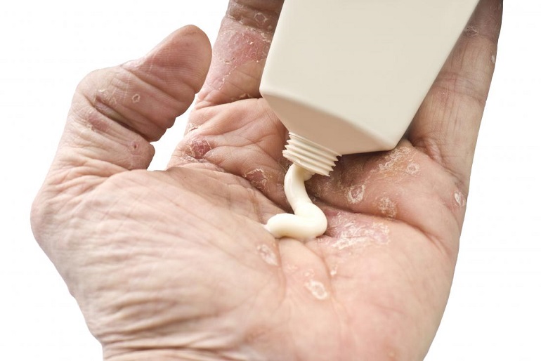 ¿Tienes psoriasis pustulosa o palmoplantar? Únete para mejorar