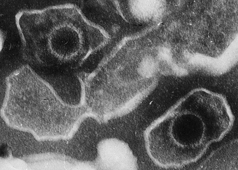 El virus de Epstein-Barr podría ser la principal causa de la esclerosis múltiple