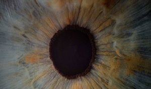 Aniridia