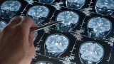 España se sitúa en la sexta posición mundial en número de publicaciones científicas sobre alzhéimer