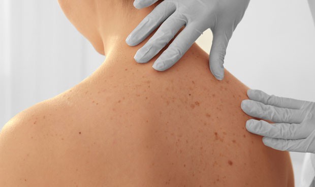 ‘Escanea tu piel’ para la detección de un posible melanoma
