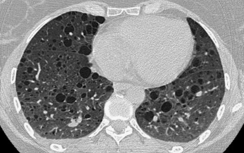 Linfangioleiomiomatosis: por fin habrá guías de práctica clínica en español
