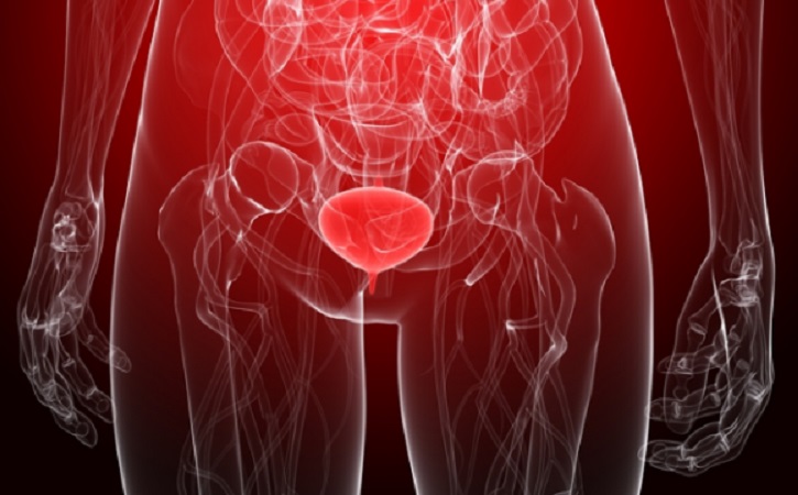 Viviendo con un cáncer de vejiga