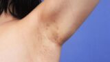 Más unidades multidisciplinares para el abordaje de la hidradenitis supurativa Más unidades multidisciplinares para el abordaje de la hidradenitis supurativa