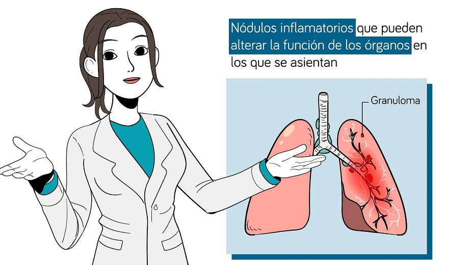 Las claves de la sarcoidosis