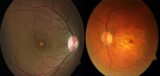 Avances en el abordaje de las distrofias hereditarias de la retina
