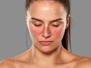 Lupus, mujer y sistema inmunológico