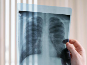 Bronquiectasias: un tipo de enfermedad rara que parece no serlo tanto