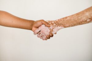 Psoriasis en las uñas: una afección poco conocida que puede avisar de artritis psoriásica