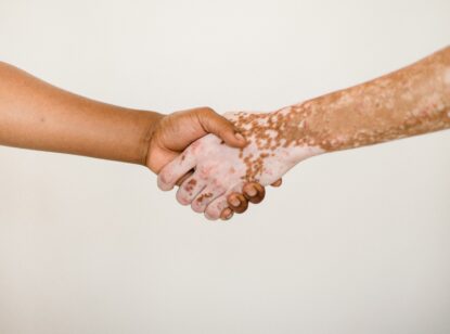 Psoriasis en las uñas: una afección poco conocida que puede avisar de artritis psoriásica