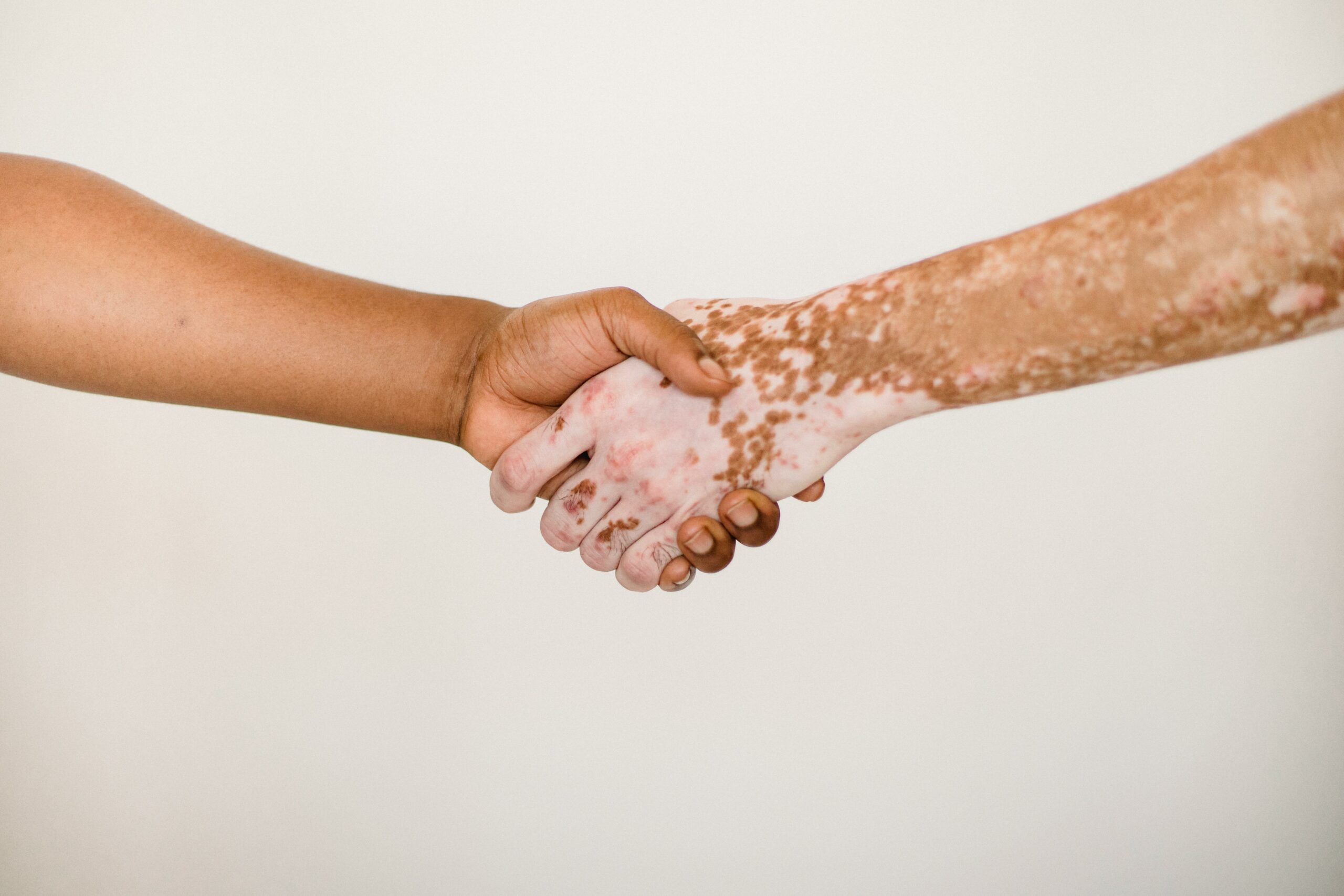 Psoriasis en las uñas: una afección poco conocida que puede avisar de artritis psoriásica