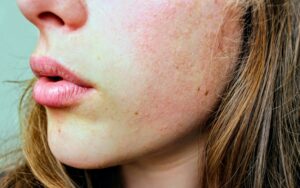 El virus del herpes labial podría estar implicado en el desarrollo del Alzheimer
