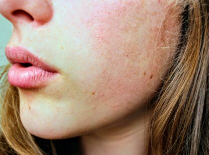 El virus del herpes labial podría estar implicado en el desarrollo del Alzheimer
