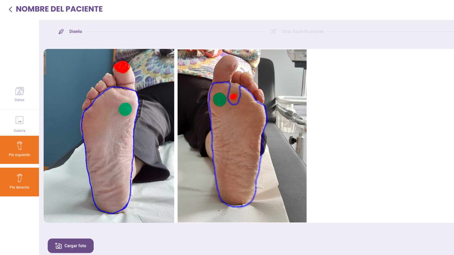 Una app con visión artificial facilita el diagnóstico y seguimiento del pie diabético desde Atención Primaria