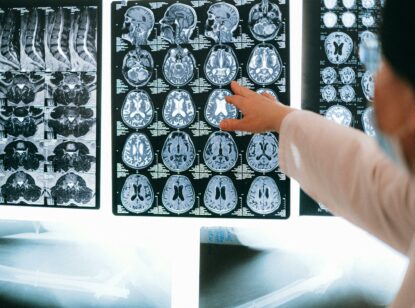 Hasta diez años de espera para diagnosticar la ataxia