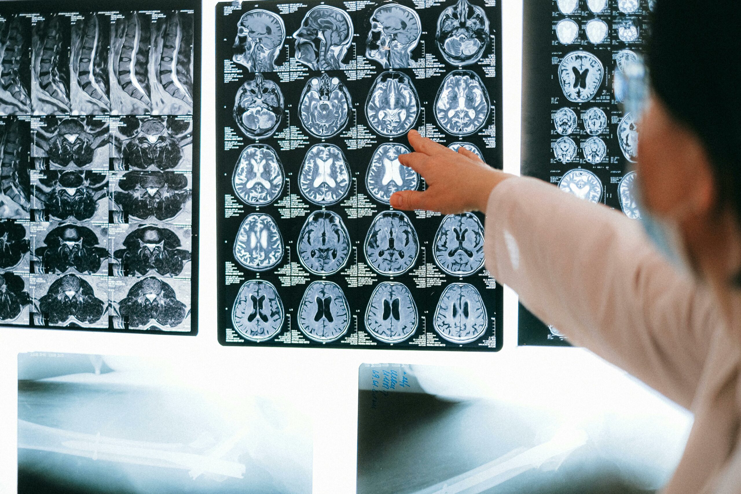 Hasta diez años de espera para diagnosticar la ataxia