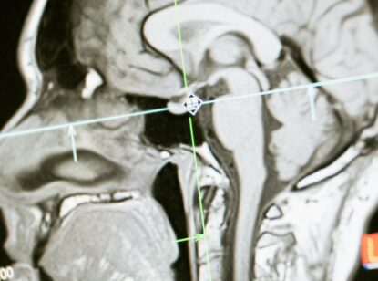 Un nuevo escáner cerebral detecta la proteína tau del alzhéimer antes que el método estándar actual
