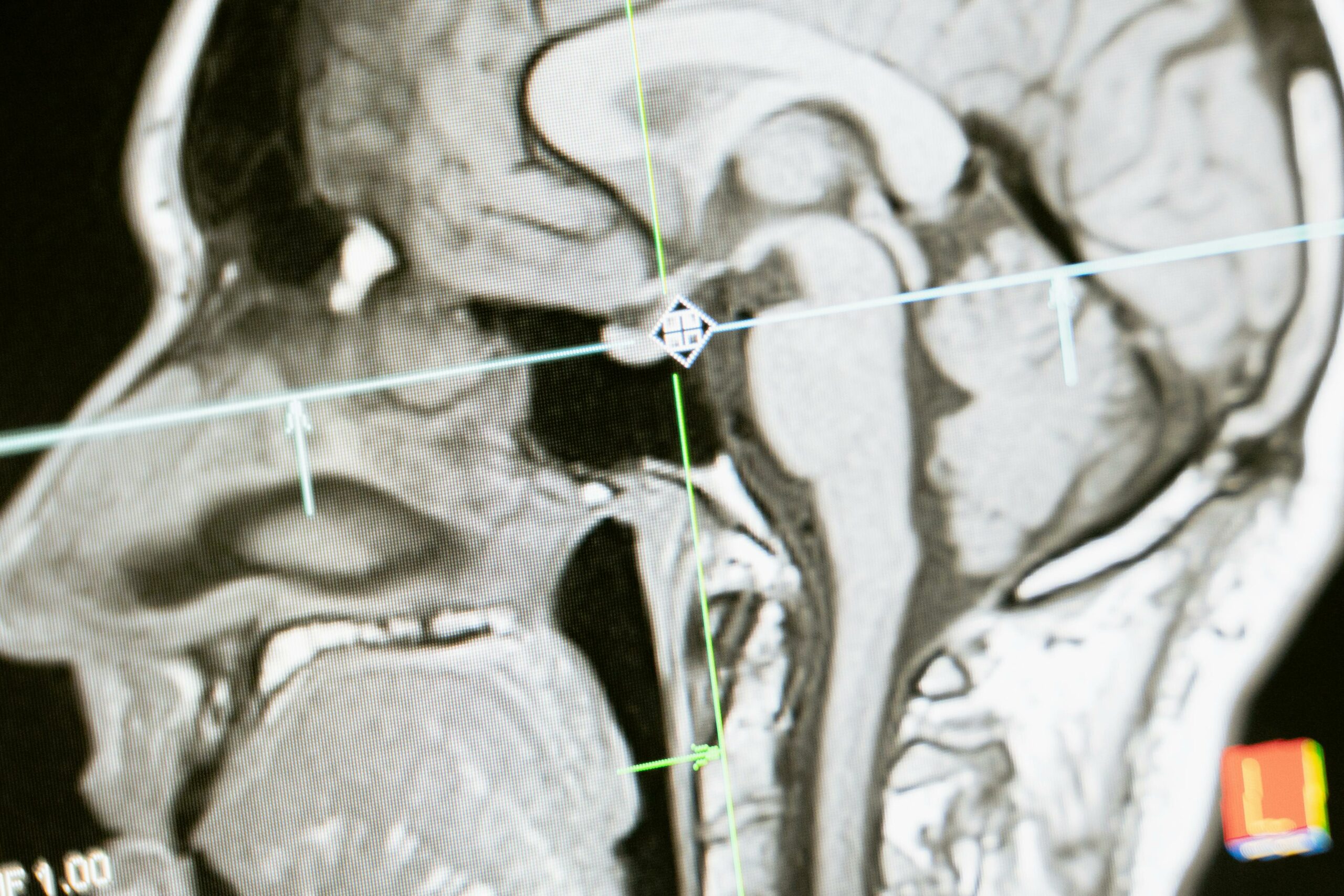 Un nuevo escáner cerebral detecta la proteína tau del alzhéimer antes que el método estándar actual